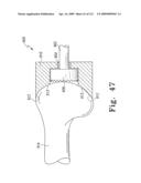 Customized Patient-Specific Bone Cutting Blocks diagram and image