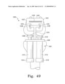 Customized Patient-Specific Bone Cutting Blocks diagram and image