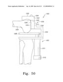 Customized Patient-Specific Bone Cutting Blocks diagram and image