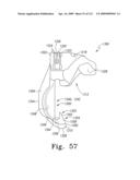 Customized Patient-Specific Bone Cutting Blocks diagram and image