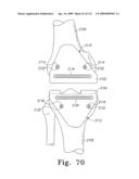 Customized Patient-Specific Bone Cutting Blocks diagram and image