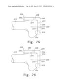 Customized Patient-Specific Bone Cutting Blocks diagram and image