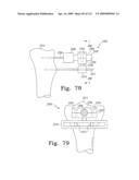 Customized Patient-Specific Bone Cutting Blocks diagram and image