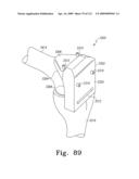 Customized Patient-Specific Bone Cutting Blocks diagram and image