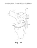 Customized Patient-Specific Bone Cutting Blocks diagram and image