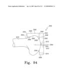 Customized Patient-Specific Bone Cutting Blocks diagram and image