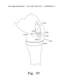 Customized Patient-Specific Bone Cutting Blocks diagram and image