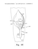 Customized Patient-Specific Bone Cutting Blocks diagram and image