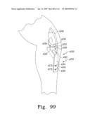 Customized Patient-Specific Bone Cutting Blocks diagram and image