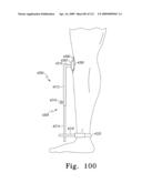 Customized Patient-Specific Bone Cutting Blocks diagram and image