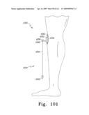 Customized Patient-Specific Bone Cutting Blocks diagram and image