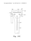 Customized Patient-Specific Bone Cutting Blocks diagram and image