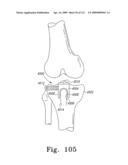 Customized Patient-Specific Bone Cutting Blocks diagram and image