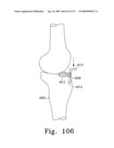 Customized Patient-Specific Bone Cutting Blocks diagram and image