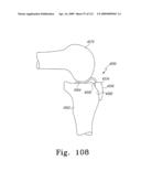 Customized Patient-Specific Bone Cutting Blocks diagram and image