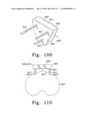 Customized Patient-Specific Bone Cutting Blocks diagram and image