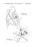 Closure device for left atrial appendage diagram and image