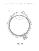 Lacrimal implant detection diagram and image