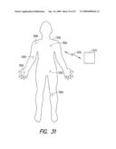 Lacrimal implant detection diagram and image