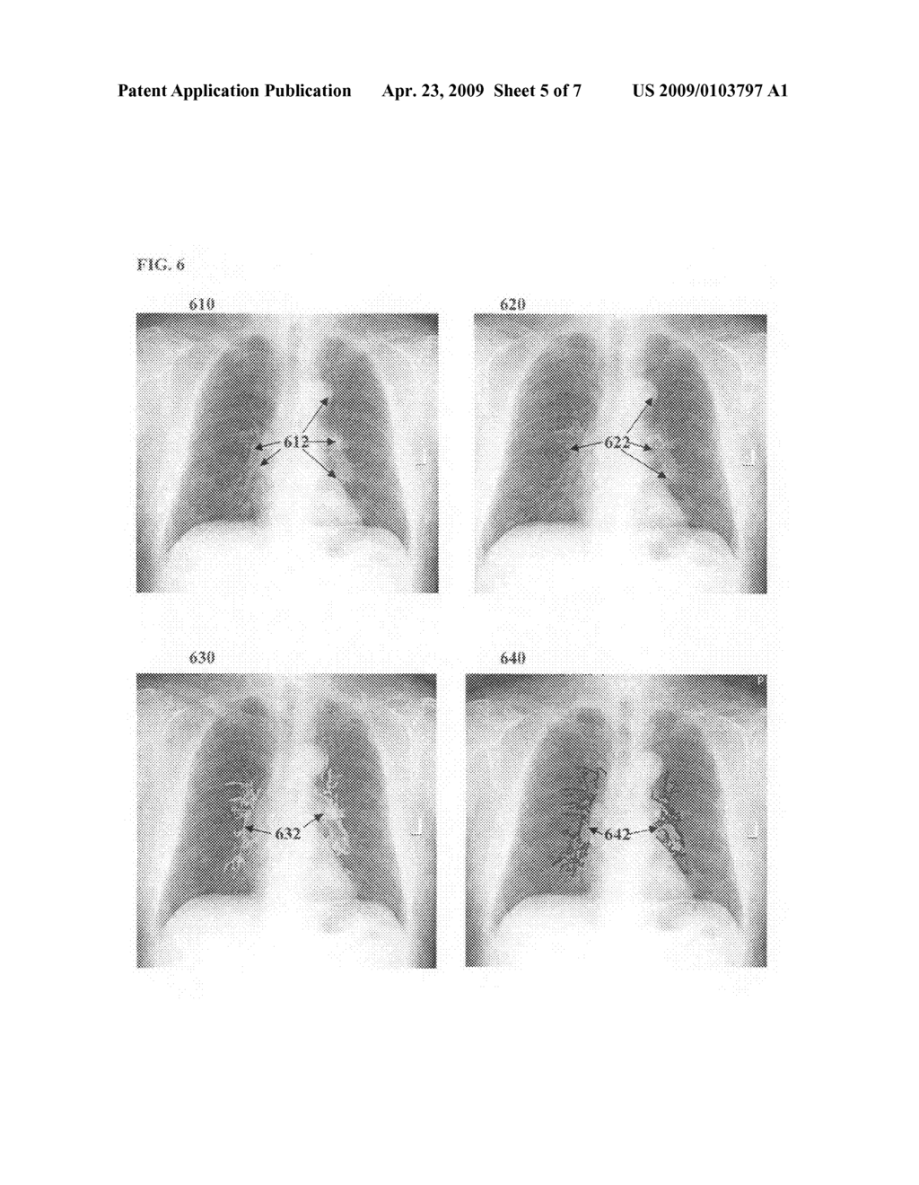 Method and system for nodule feature extraction using background contextual information in chest x-ray images - diagram, schematic, and image 06