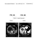 Methods of Treating Cancers with SAHA, Carboplatin, and Paclitaxel and Other Combination Therapies diagram and image