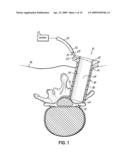 SURGICAL ACCESS SYSTEM AND METHOD OF USING THE SAME diagram and image