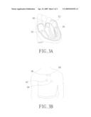 METHOD AND DEVICE FOR AUTOMATICALLY DETERMINING HEART VALVE DAMAGE diagram and image