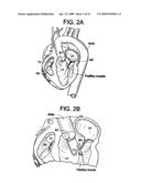 SYSTEM USING A HELICAL RETAINER IN THE DIRECT PLICATION ANNULOPLASTY TREATMENT OF MITRAL VALVE REGURGITATION diagram and image