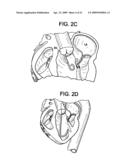 SYSTEM USING A HELICAL RETAINER IN THE DIRECT PLICATION ANNULOPLASTY TREATMENT OF MITRAL VALVE REGURGITATION diagram and image