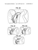 SYSTEM USING A HELICAL RETAINER IN THE DIRECT PLICATION ANNULOPLASTY TREATMENT OF MITRAL VALVE REGURGITATION diagram and image