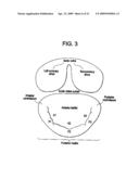 SYSTEM USING A HELICAL RETAINER IN THE DIRECT PLICATION ANNULOPLASTY TREATMENT OF MITRAL VALVE REGURGITATION diagram and image