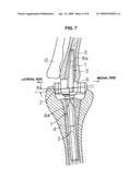 Artificial elbow joint diagram and image