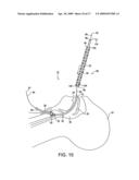 System for providing an open airway and methods of use thereof diagram and image