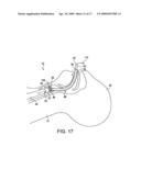 System for providing an open airway and methods of use thereof diagram and image