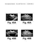 SYSTEM AND METHOD FOR MEASURING BLADDER WALL THICKNESS AND PRESENTING A BLADDER VIRTUAL IMAGE diagram and image