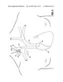 SHEATHLESS INSERTION STYLET SYSTEM FOR CATHETER PLACEMENT diagram and image