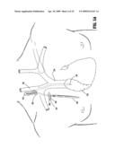 SHEATHLESS INSERTION STYLET SYSTEM FOR CATHETER PLACEMENT diagram and image