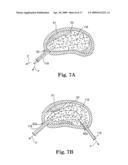 SYSTEM AND METHOD FOR MEASURING THE SHAPE OF INTERNAL BODY CAVITIES diagram and image