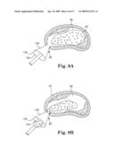 SYSTEM AND METHOD FOR MEASURING THE SHAPE OF INTERNAL BODY CAVITIES diagram and image