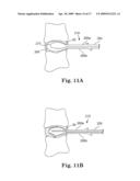 SYSTEM AND METHOD FOR MEASURING THE SHAPE OF INTERNAL BODY CAVITIES diagram and image