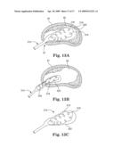 SYSTEM AND METHOD FOR MEASURING THE SHAPE OF INTERNAL BODY CAVITIES diagram and image