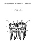 System to whiten interproximal surfaces of adjacent teeth diagram and image