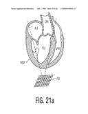 Three Dimensional Ultrasonic Scanning With a Steerable Volumetric Region diagram and image