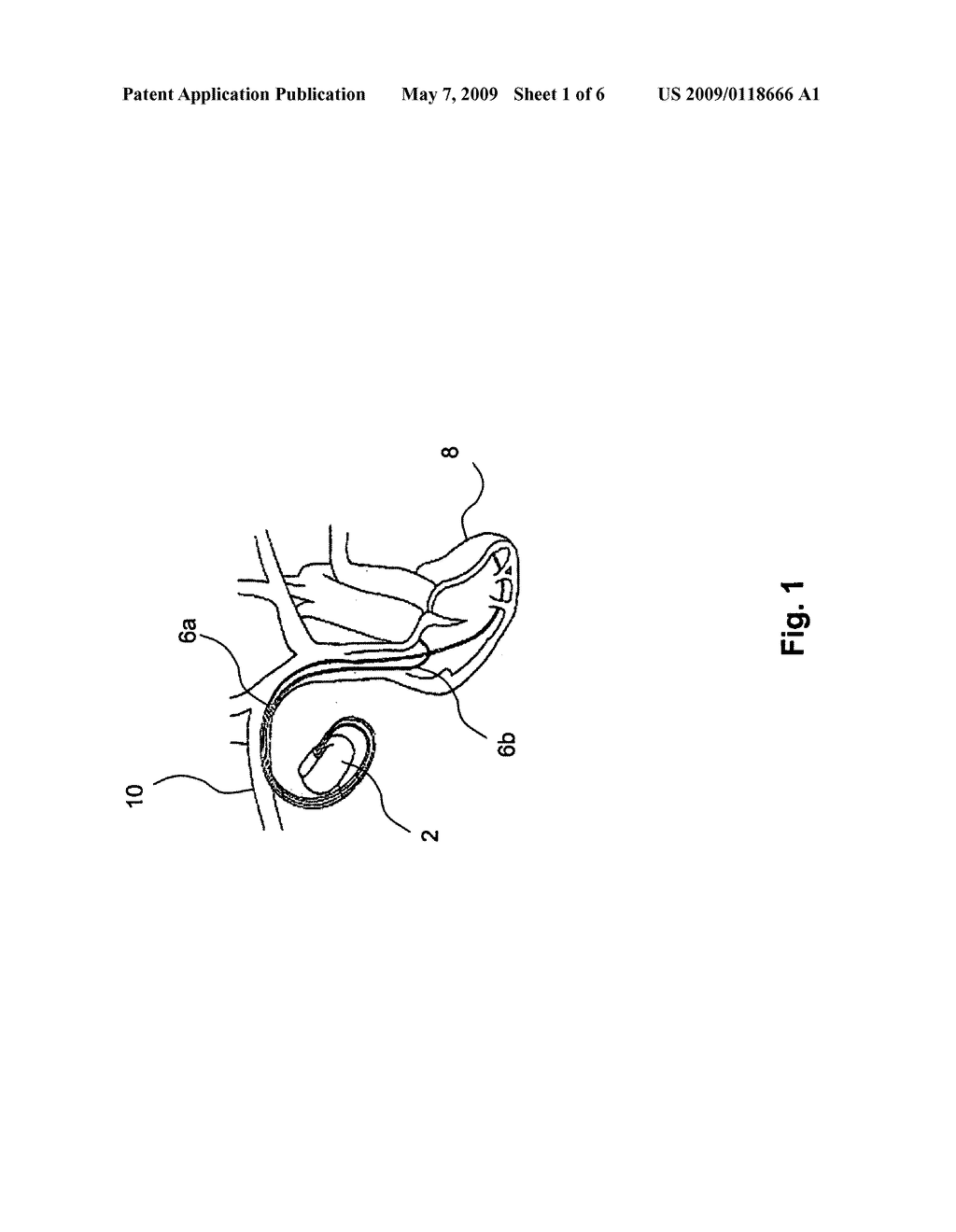 Method and implantable device for measuring hematocrit - diagram, schematic, and image 02