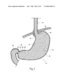 Systems and methods for treating obesity and other gastrointestinal conditions diagram and image