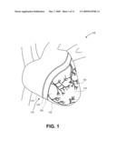 METHOD FOR TREATING CORONARY VESSELS diagram and image