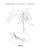 METHOD FOR TREATING CORONARY VESSELS diagram and image