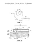 METHOD FOR TREATING CORONARY VESSELS diagram and image