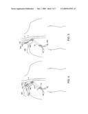 METHODS AND APPARATUS FOR INSERTING MULTI-LUMEN SPLIT-TIP CATHETERS INTO A BLOOD VESSEL diagram and image