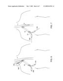 METHODS AND APPARATUS FOR INSERTING MULTI-LUMEN SPLIT-TIP CATHETERS INTO A BLOOD VESSEL diagram and image